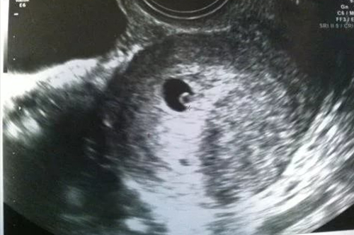 Беременность 5 недель фото. УЗИ на 6 акушерской неделе. 5 Недель. Беременности УЗИ 2 плода. 5 Акушерская неделя беременности. УЗИ эмбриона 5 недель 2 дня.